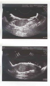 Ultrasound of the mass in Stormy's neck